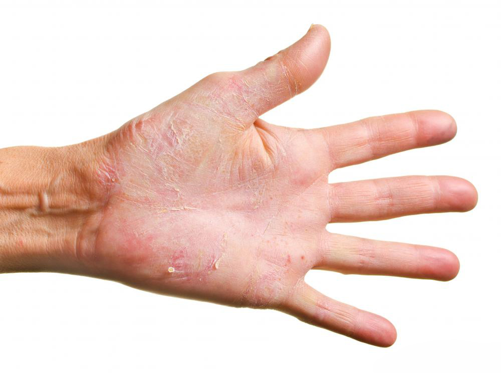 Dermatitis Herpetiformis Nedir?